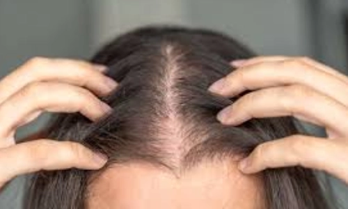 Hair Loss Treatment