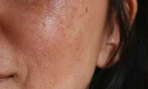 Melasma Treatment