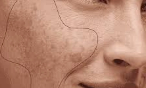 Pigmentation Treatment