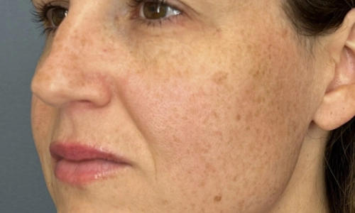 Skin Rejuvenation