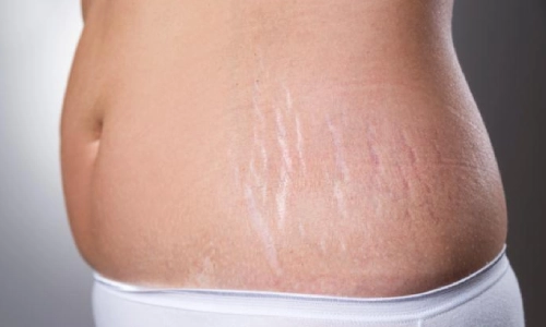 Stretch Mark Removal